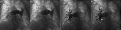 Effect of Levosimendan on Acute Decompensated Right Heart Failure in Patients With Connective Tissue Disease-Associated Pulmonary Arterial Hypertension